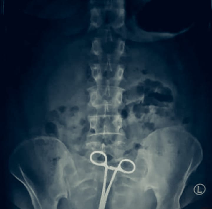 Scissors Found Inside Patients Stomach 35 Days Following Surgery